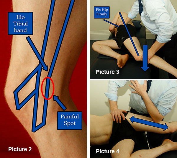 Sore part of runner's knee, Ober's test ITB, ITB massage