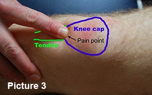 Patella tendon pain